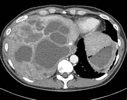 Biliary Cystadenocarcinoma - Liver Case Studies - CTisus CT Scanning