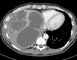 Biliary Cystadenocarcinoma - CTisus CT Scan