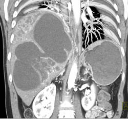 Biliary Cystadenocarcinoma - CTisus CT Scan