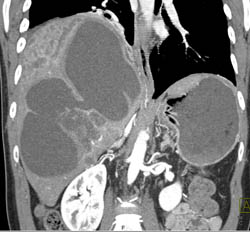 Biliary Cystadenocarcinoma - CTisus CT Scan