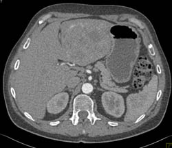 Hepatoma and Incidental Gastric Cancer - CTisus CT Scan