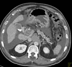 Hepatoma - CTisus CT Scan