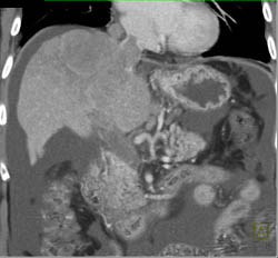 Hepatoma Extends Into the IVC - CTisus CT Scan