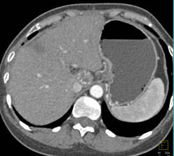 Hepatoma in Caudate Lobe With Cirrhosis - CTisus CT Scan