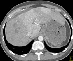 Hepatocellular Carcinoma (HCC) With Portal Vein Thrombosis (PVT) - CTisus CT Scan