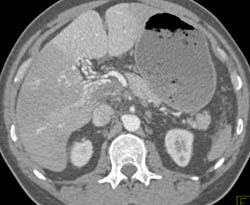 Partial Portal Vein Thrombosis With Cavernous Transformation of the Portal Vein (CTPV) - CTisus CT Scan