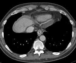 Partial Portal Vein Thrombosis With Esophageal and Gastric Varices - CTisus CT Scan