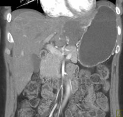 Hemangioma - CTisus CT Scan