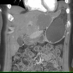 Hemangioma - CTisus CT Scan