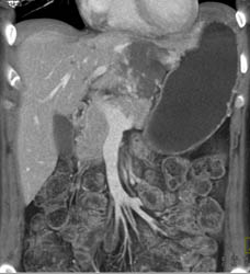 Hemangioma - CTisus CT Scan