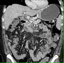 Pancreatic Cancer Occludes Portal Vein and Infiltrates Mesentery - CTisus CT Scan