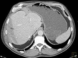 Radiation Hepatitis in Liver Following RT Therapy to Bone Lesion - CTisus CT Scan