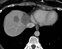 Changes From Radiofrequency Ablation (RFA) - CTisus CT Scan