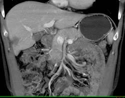 Focal Infarct Vs Scan in Liver - CTisus CT Scan