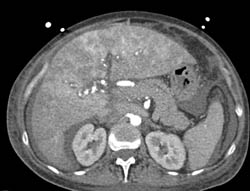 Congested Liver With Perfusion Changes - CTisus CT Scan