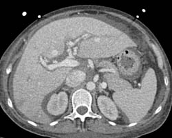 Periportal Edema - Liver Case Studies - CTisus CT Scanning