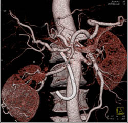 Common Duct Tumor - CTisus CT Scan