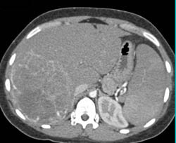 Hepatoma With Splenic Infarcts. Key Is Neovascularity - CTisus CT Scan