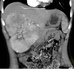 Multifocal Hepatoma - CTisus CT Scan