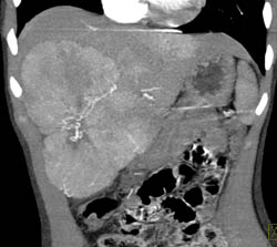 Multifocal Hepatoma - CTisus CT Scan