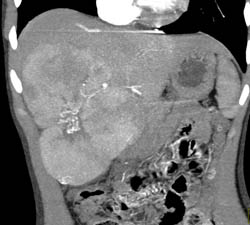 Multifocal Hepatoma - CTisus CT Scan