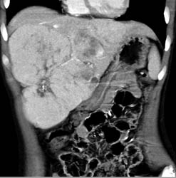 Multifocal Hepatoma - CTisus CT Scan