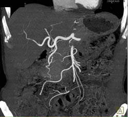 Multifocal Hepatoma - CTisus CT Scan