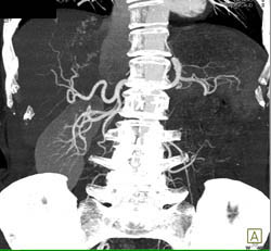 Multifocal Hepatoma - CTisus CT Scan