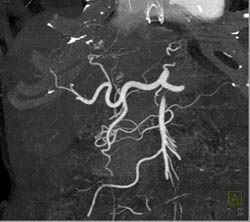 Multifocal Hepatoma - CTisus CT Scan