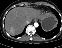 Focal Nodular Hyperplasia (FNH) Vs Hemangiomas. Final Answer Was FNH - CTisus CT Scan