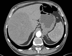 Hepatoma - CTisus CT Scan