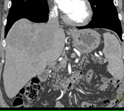 Hepatoma - CTisus CT Scan