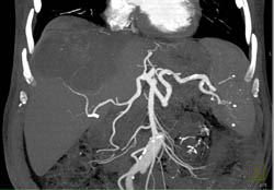 Hepatoma - CTisus CT Scan