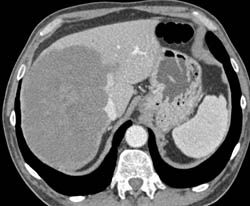 Hepatoma - CTisus CT Scan