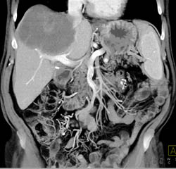 Hepatoma - CTisus CT Scan