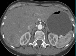 Hepatoma With Nodes Near Porta - CTisus CT Scan