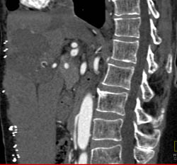 Hemangioma - CTisus CT Scan