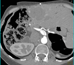 Hemangioma - CTisus CT Scan