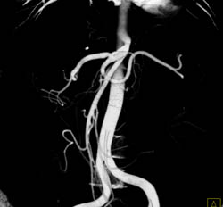 Hemangioma - CTisus CT Scan