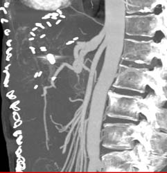 Hemangioma - CTisus CT Scan