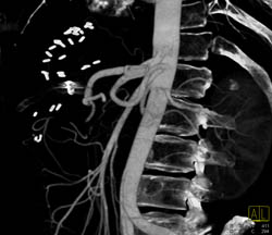 Hemangioma - CTisus CT Scan