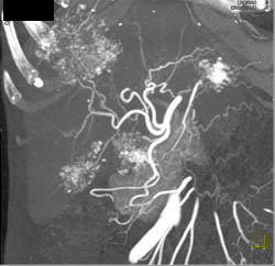 Metastatic Islet Cell Tumor - CTisus CT Scan