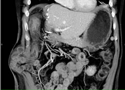 Post Op Changes S/p Right Lobe of Liver Resection. Incidental Hernia Through Abdominal Wall Incision - CTisus CT Scan