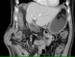 Post Op Changes S/p Right Lobe of Liver Resection. Incidental Hernia Through Abdominal Wall Incision - CTisus CT Scan