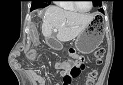 Post Op Changes S/p Right Lobe of Liver Resection. Incidental Hernia Through Abdominal Wall Incision - CTisus CT Scan