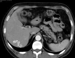 Liver Calcifications Probably Due to Prior Infection - CTisus CT Scan