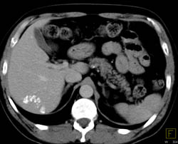 Liver Calcifications Probably Due to Prior Infection - CTisus CT Scan