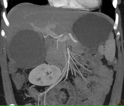 Hepatic Cyst - CTisus CT Scan