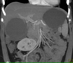 Hepatic Cyst - CTisus CT Scan