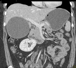 Hepatic Cyst - CTisus CT Scan